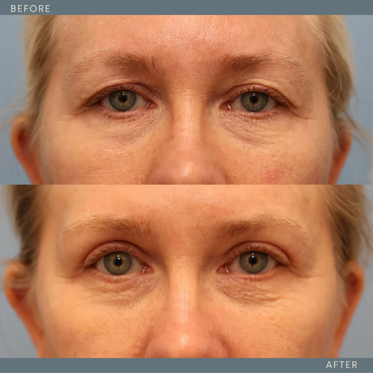   Upper Blepharoplasty  