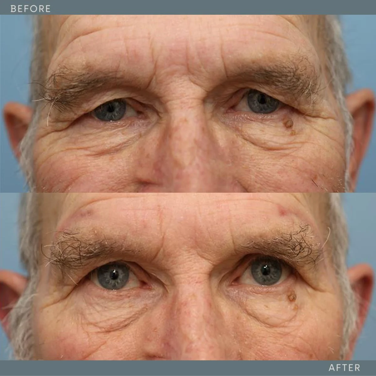   Upper Blepharoplasty, Temporal browlift  