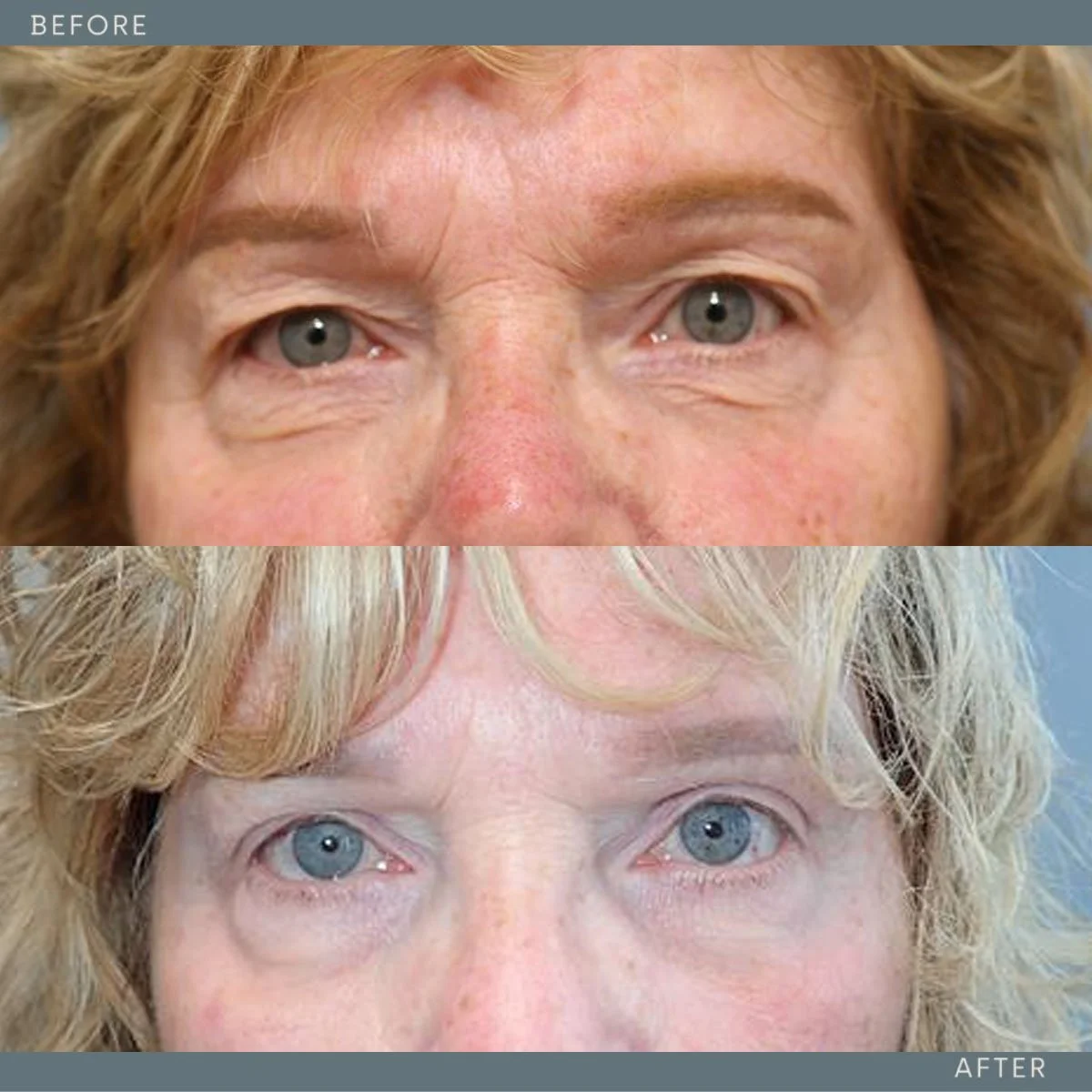   Upper Blepharoplasty  