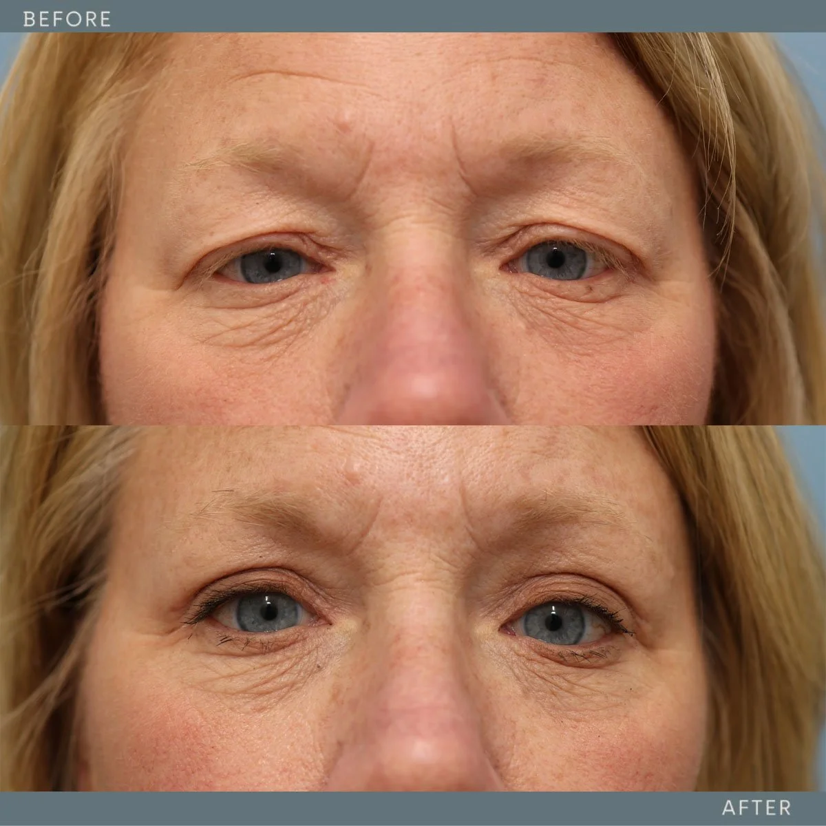   Upper Blepharoplasty  