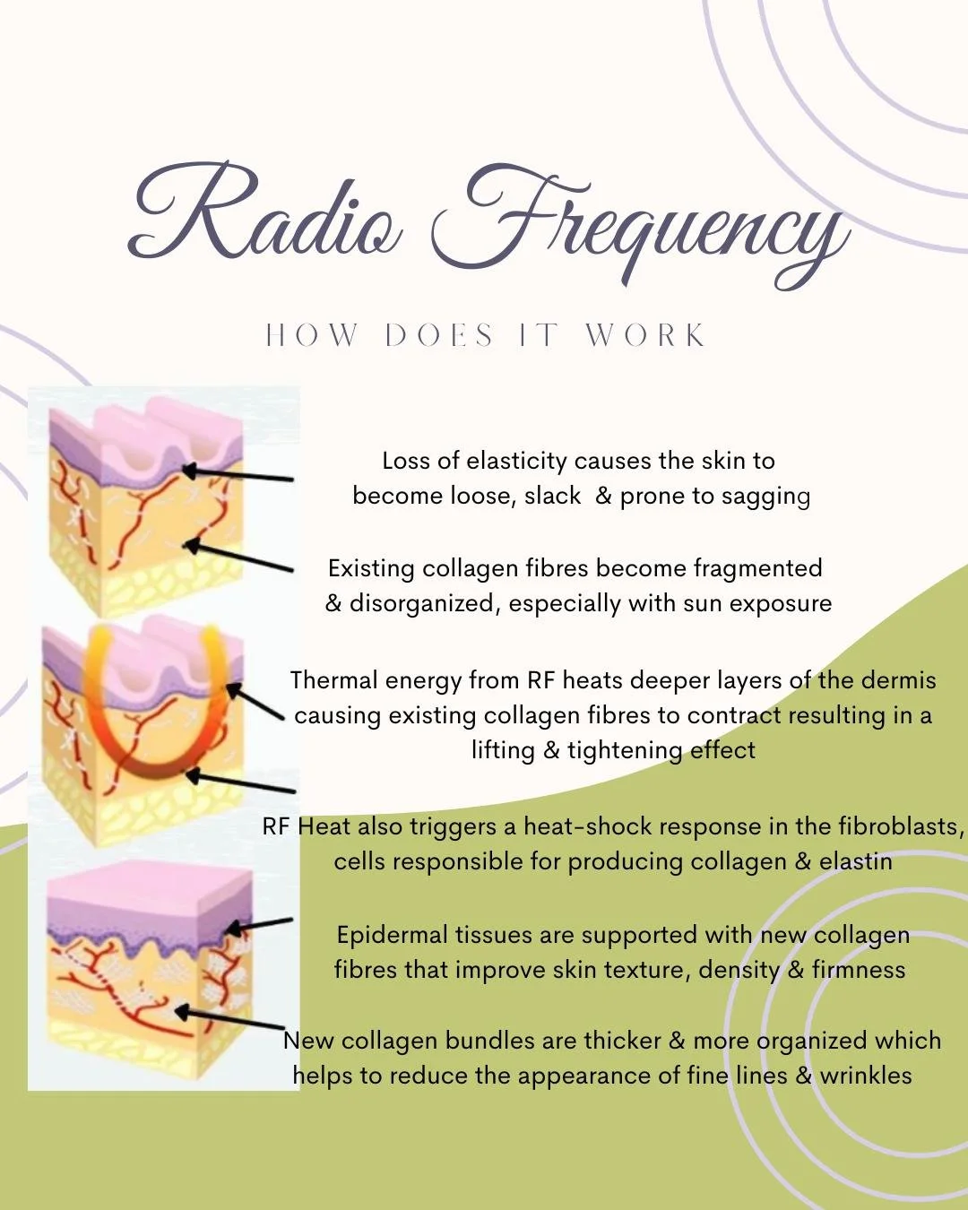 Experience next-level skin renewal.

This advanced treatment deeply cleanses, exfoliates, and infuses hydration, while Radio Frequency technology lifts, firms, and restores your natural radiance from within.

💧 Smooths fine lines &amp; wrinkles
⚡ Fi