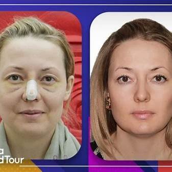 Post-Cosmetic Surgery MLD: What Your Surgeon May Not Tell You