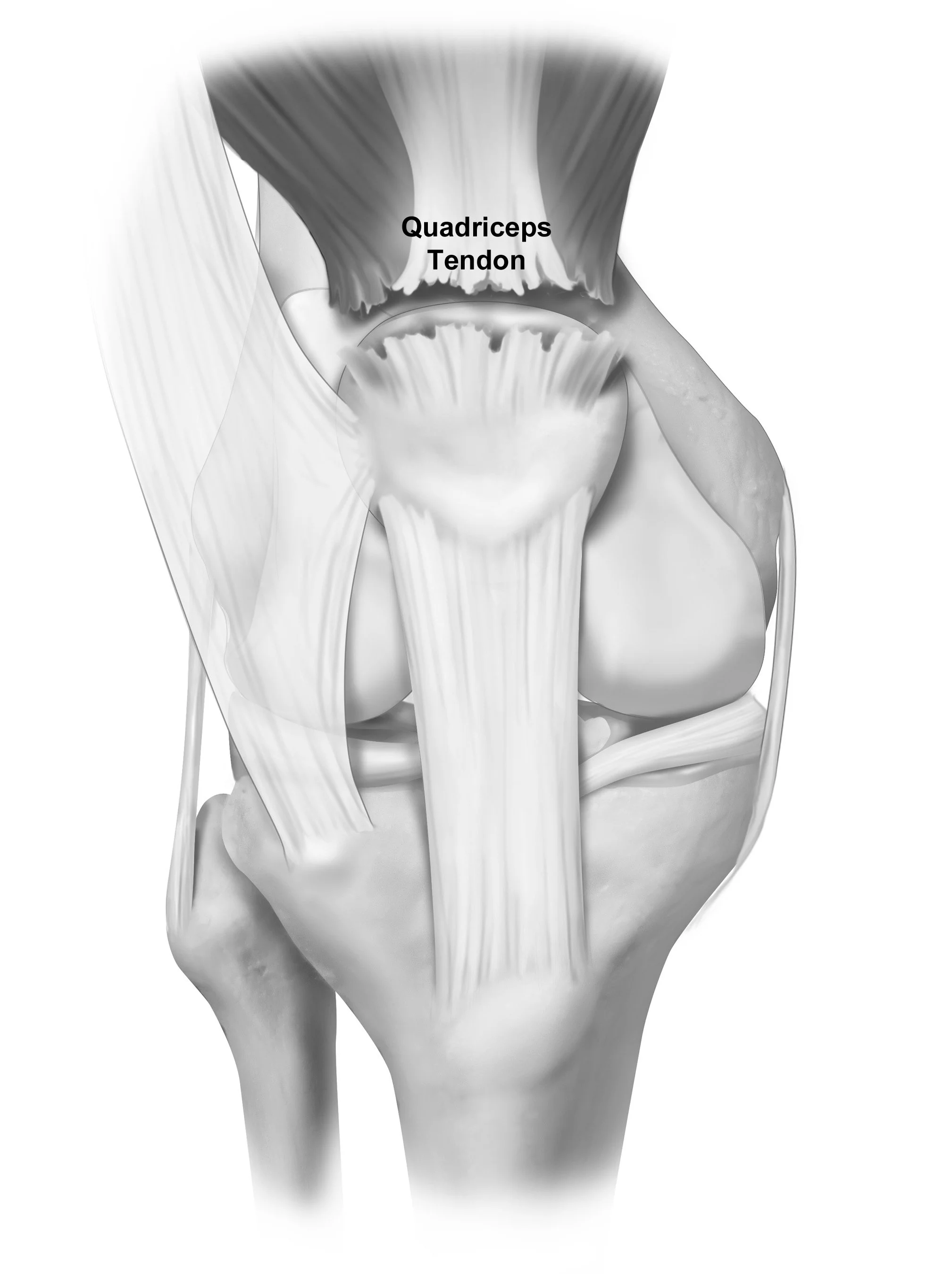 Torn Quad Tendon Recovery _ The Difference Between a Pulled and Torn ...