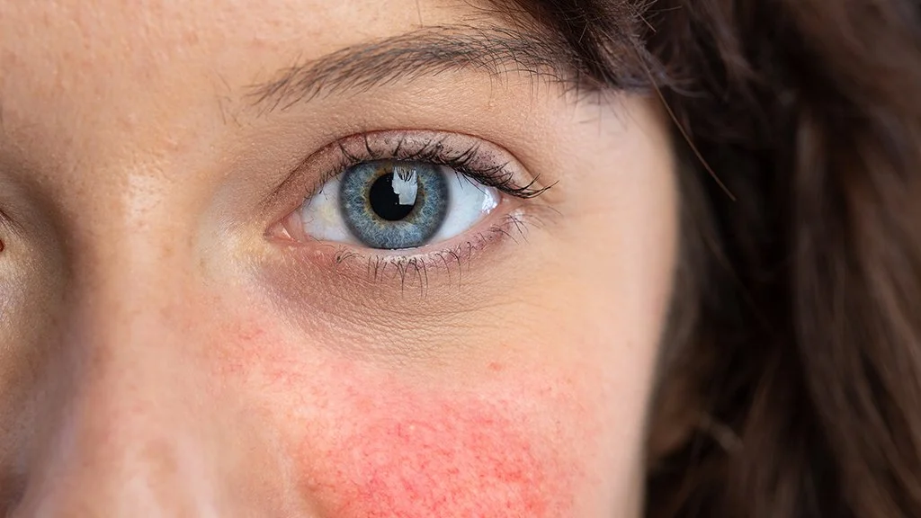 How is Sleep Connected to Rosacea?