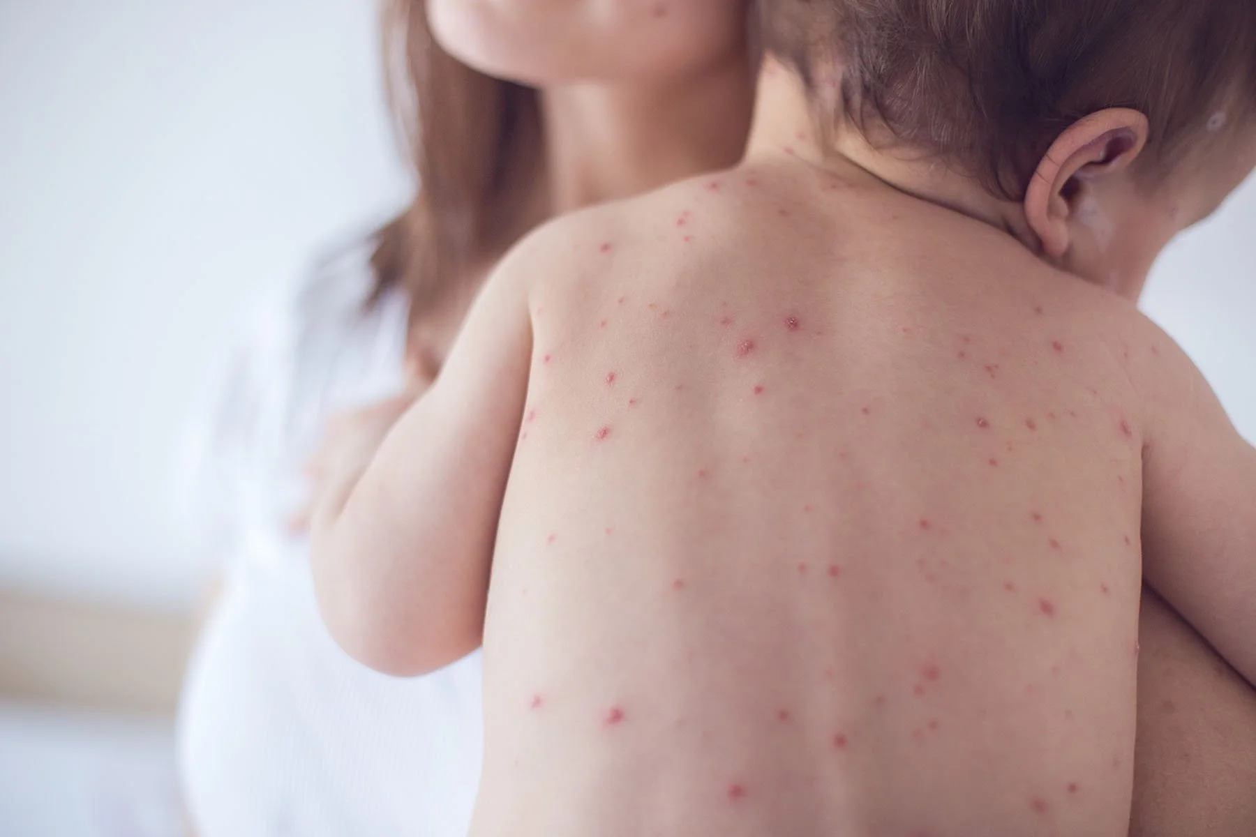 Scarlet Fever: An Ongoing Concern in Public Health