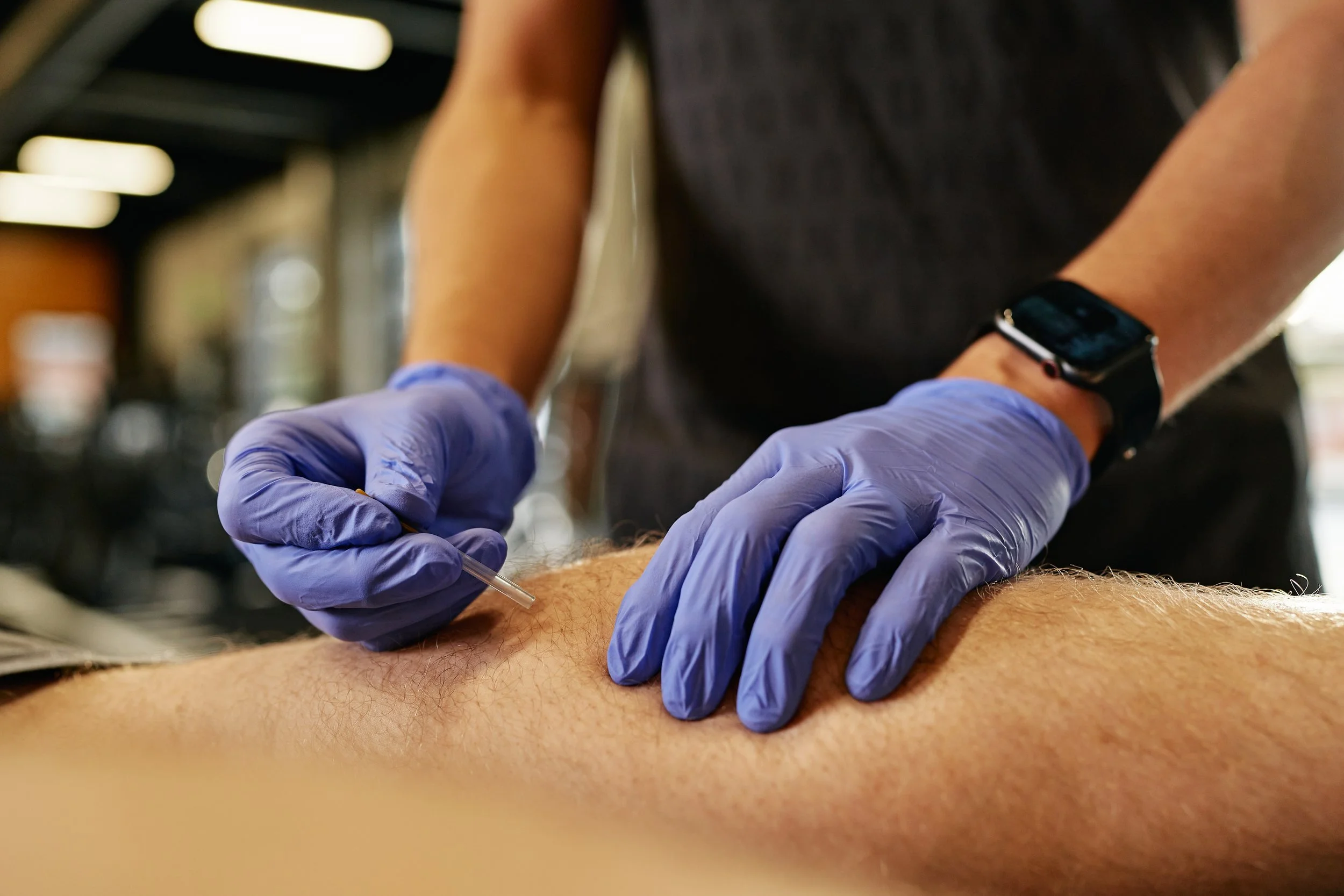 What is Dry Needling?