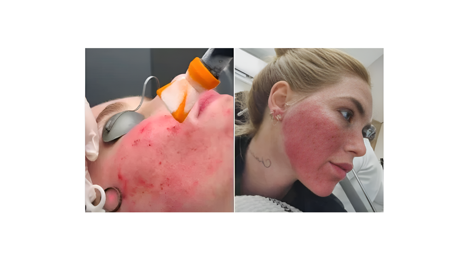 Rejuvenescimento, cicatrizes de acne e qualidade da pele: a ciência por trás do procedimento de Virgínia Fonseca com o Fotona StarWalker