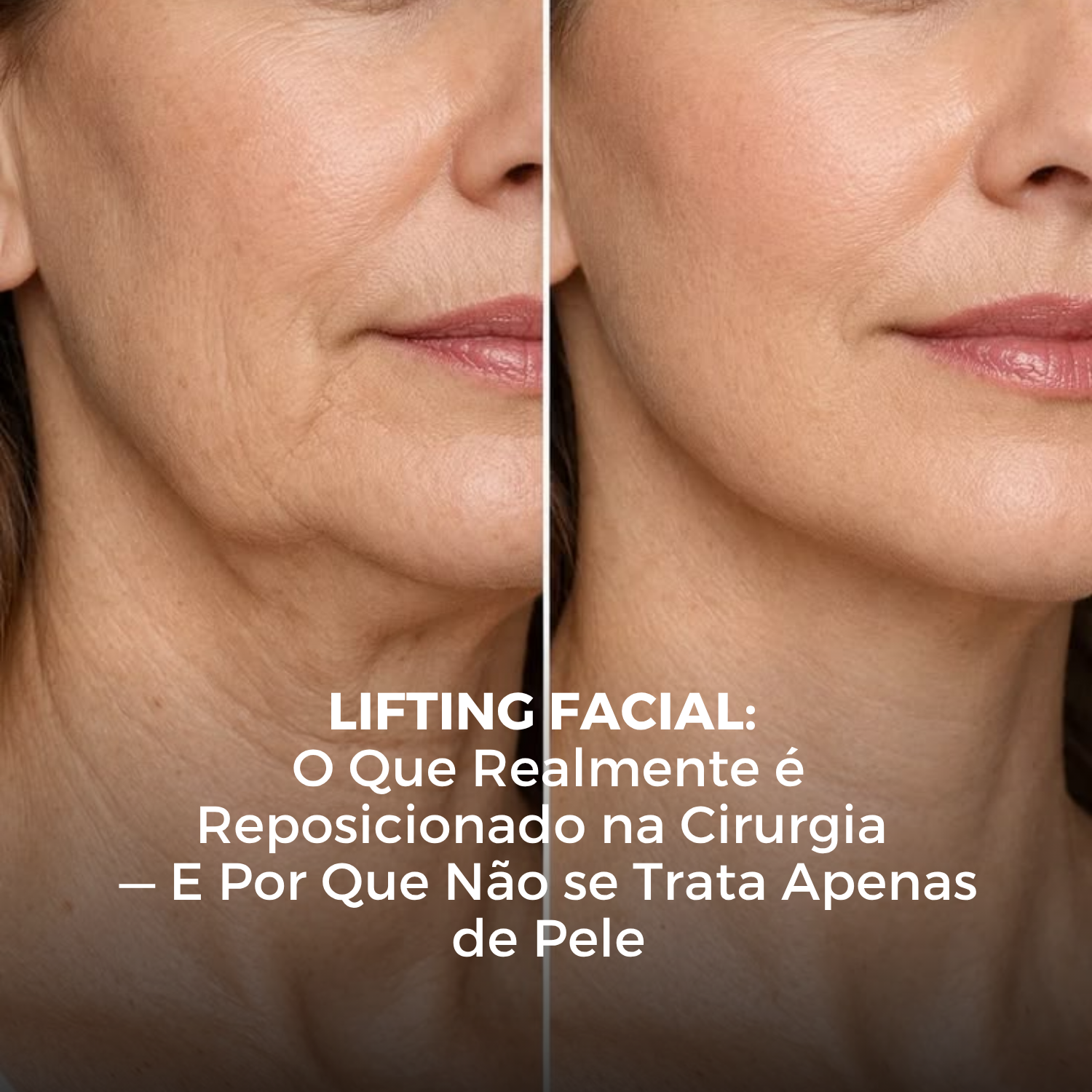 Lifting Facial: O Que Realmente é Reposicionado na Cirurgia — E Por Que Não se Trata Apenas de Pele