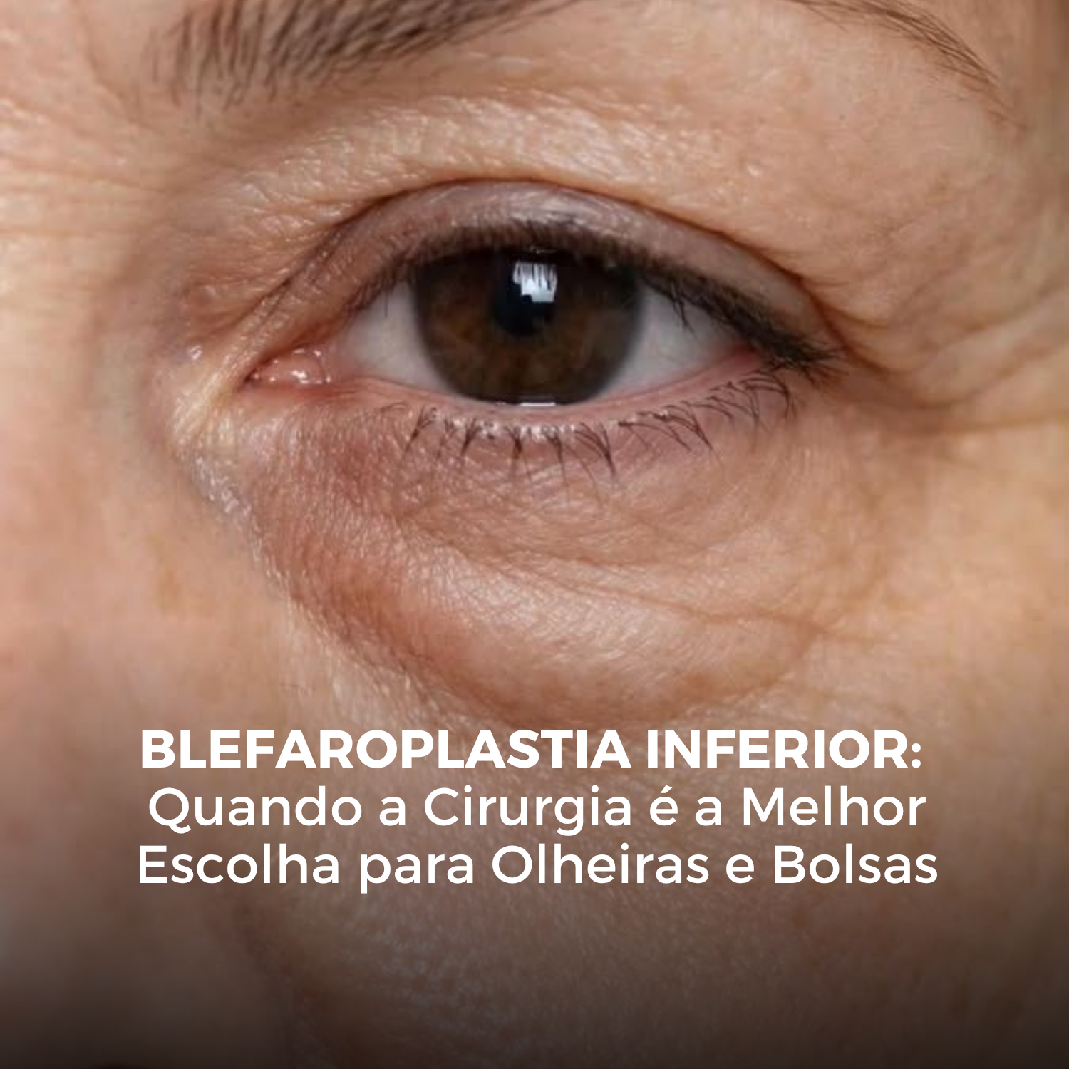 Blefaroplastia Inferior: Quando a Cirurgia é a Melhor Escolha para Olheiras e Bolsas