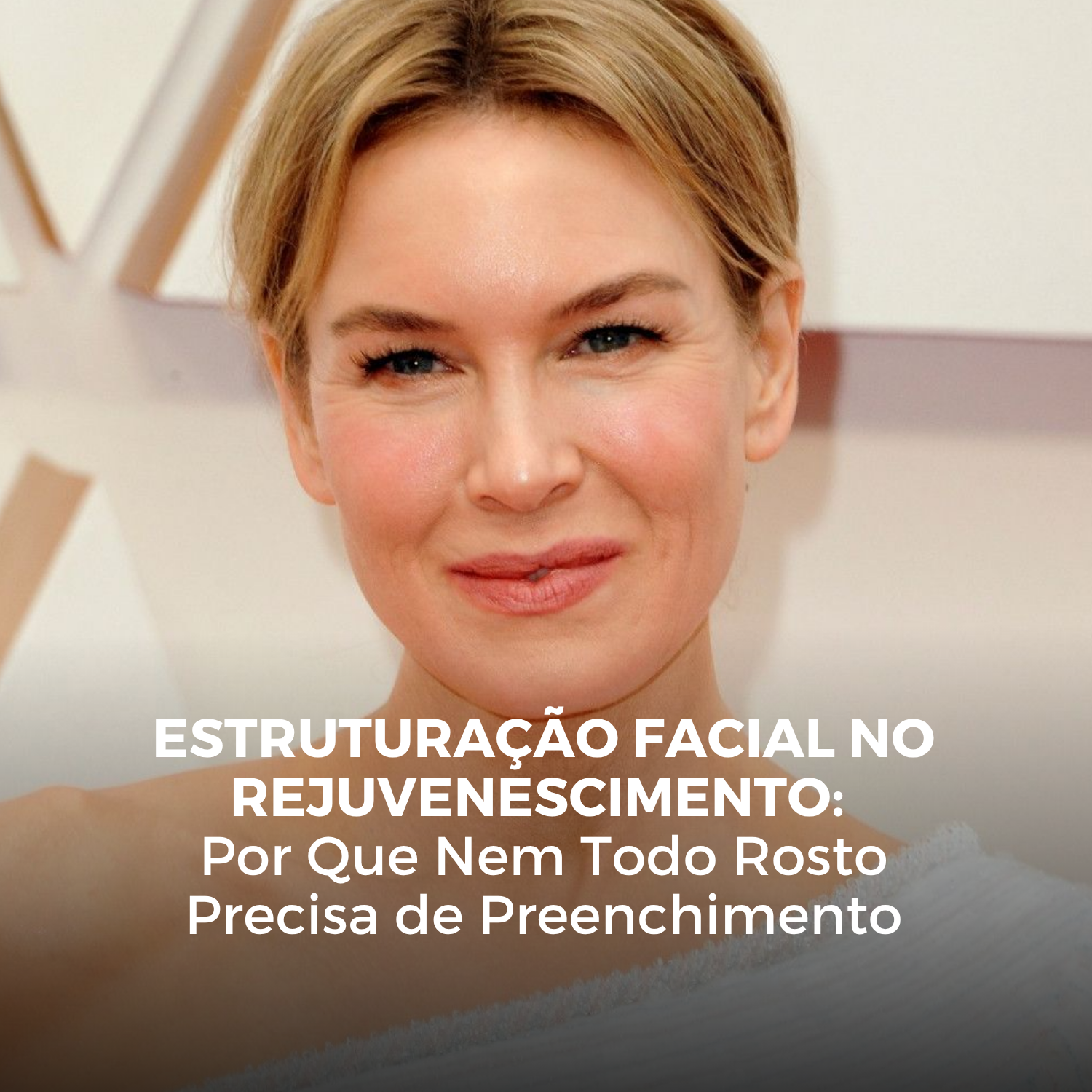 Estruturação Facial no Rejuvenescimento: Por Que Nem Todo Rosto Precisa de Preenchimento