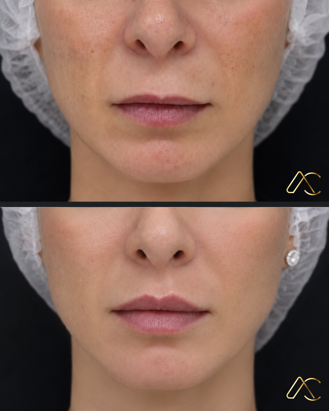 Lip Lift: a cirurgia que encurta o lábio superior e devolve o sorriso jovem