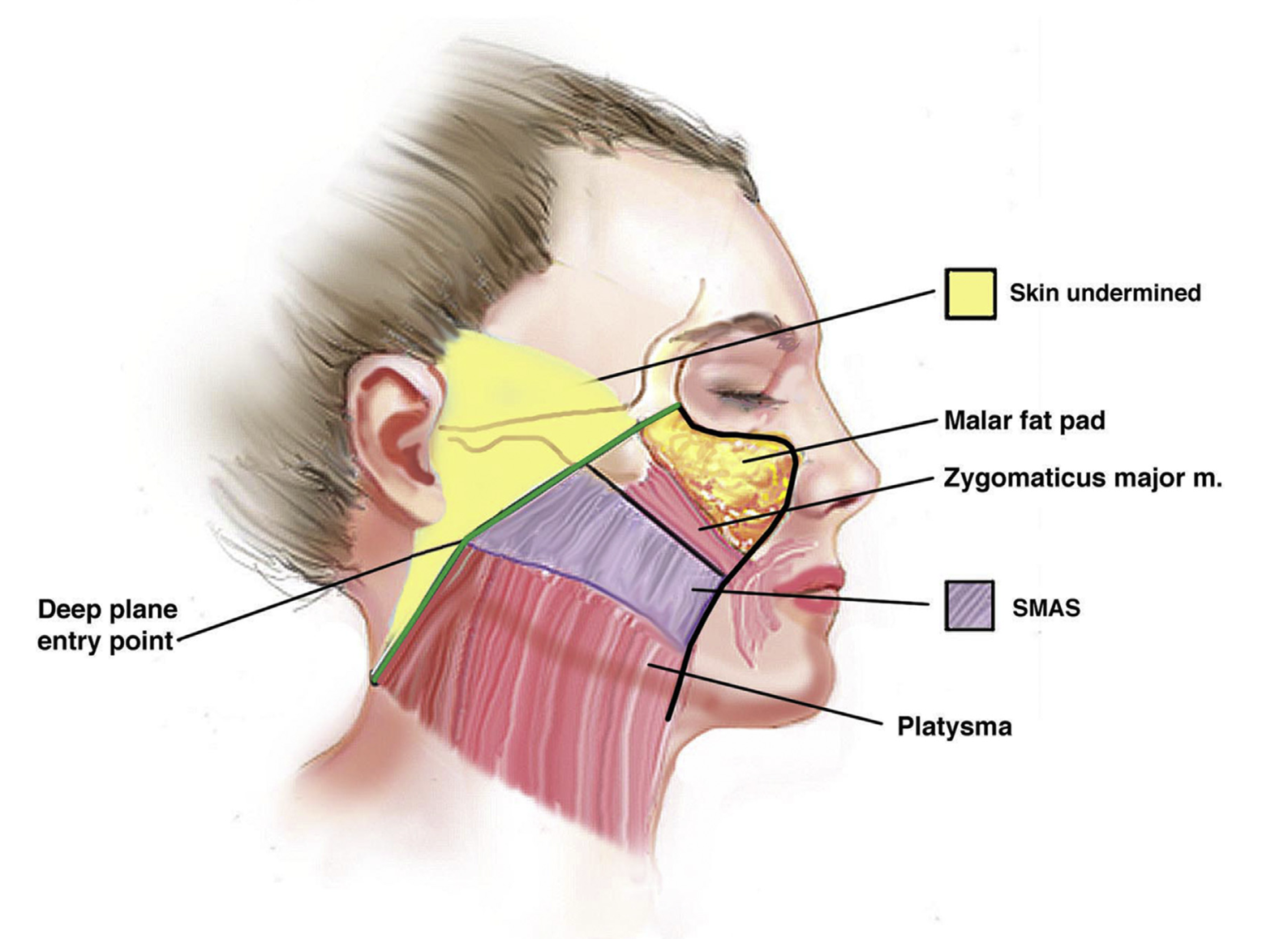 O que é o SMAS e por que ele é o verdadeiro alicerce do rejuvenescimento facial