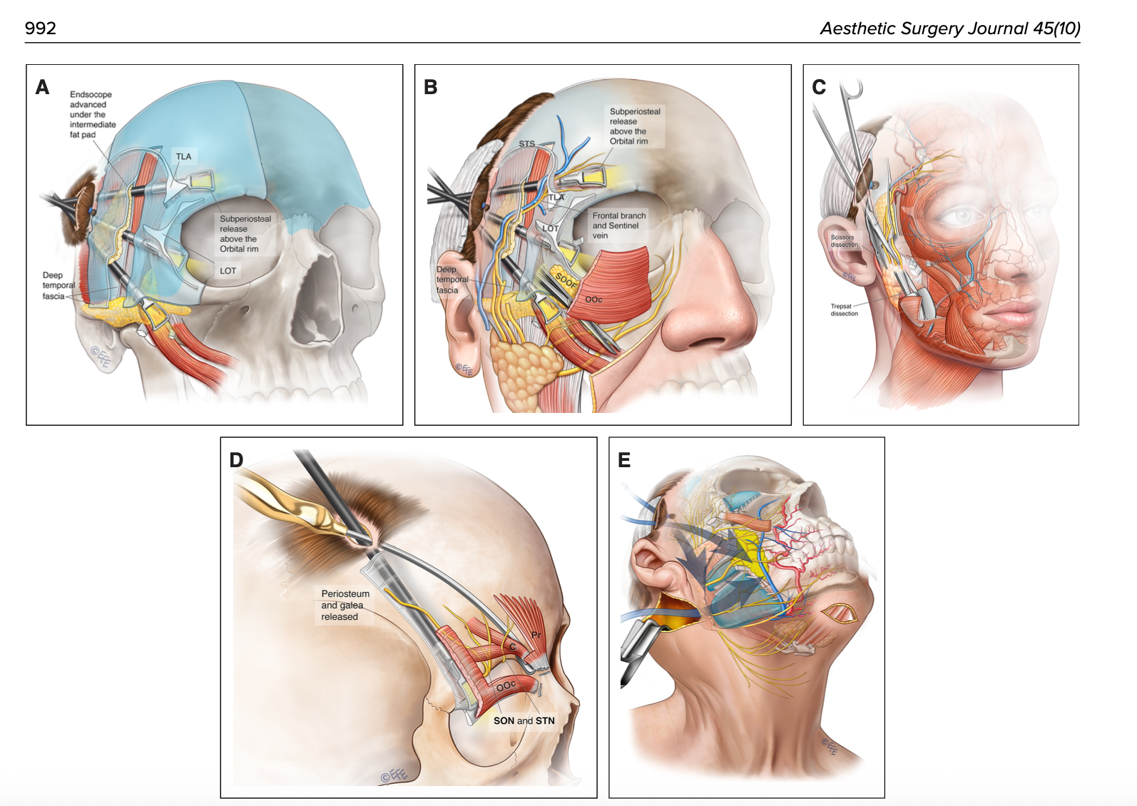 A história da cirurgia da face: da trend dos anos 80 ao lifting endoscópico em plano profundo