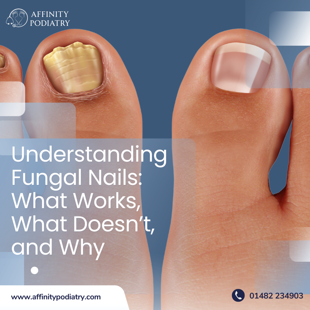 Understanding Fungal Nails: What Works, What Doesn’t, and Why