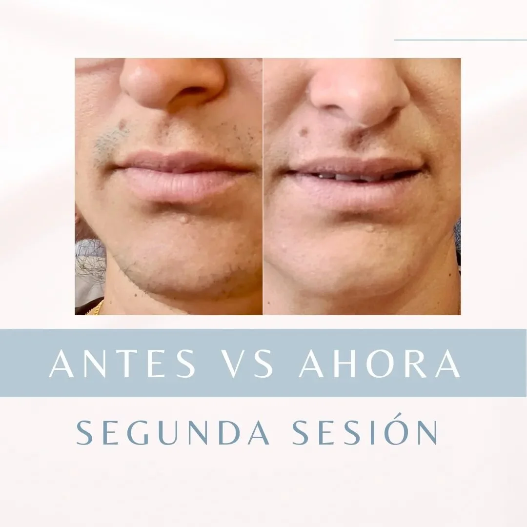 En cada sesi&oacute;n de depilaci&oacute;n l&aacute;ser, notar&aacute;s c&oacute;mo los vellos se vuelven m&aacute;s finos y escasos. &iexcl;Es un proceso gradual pero efectivo! 💪🌟 Desp&iacute;dete de las preocupaciones diarias por el vello no dese