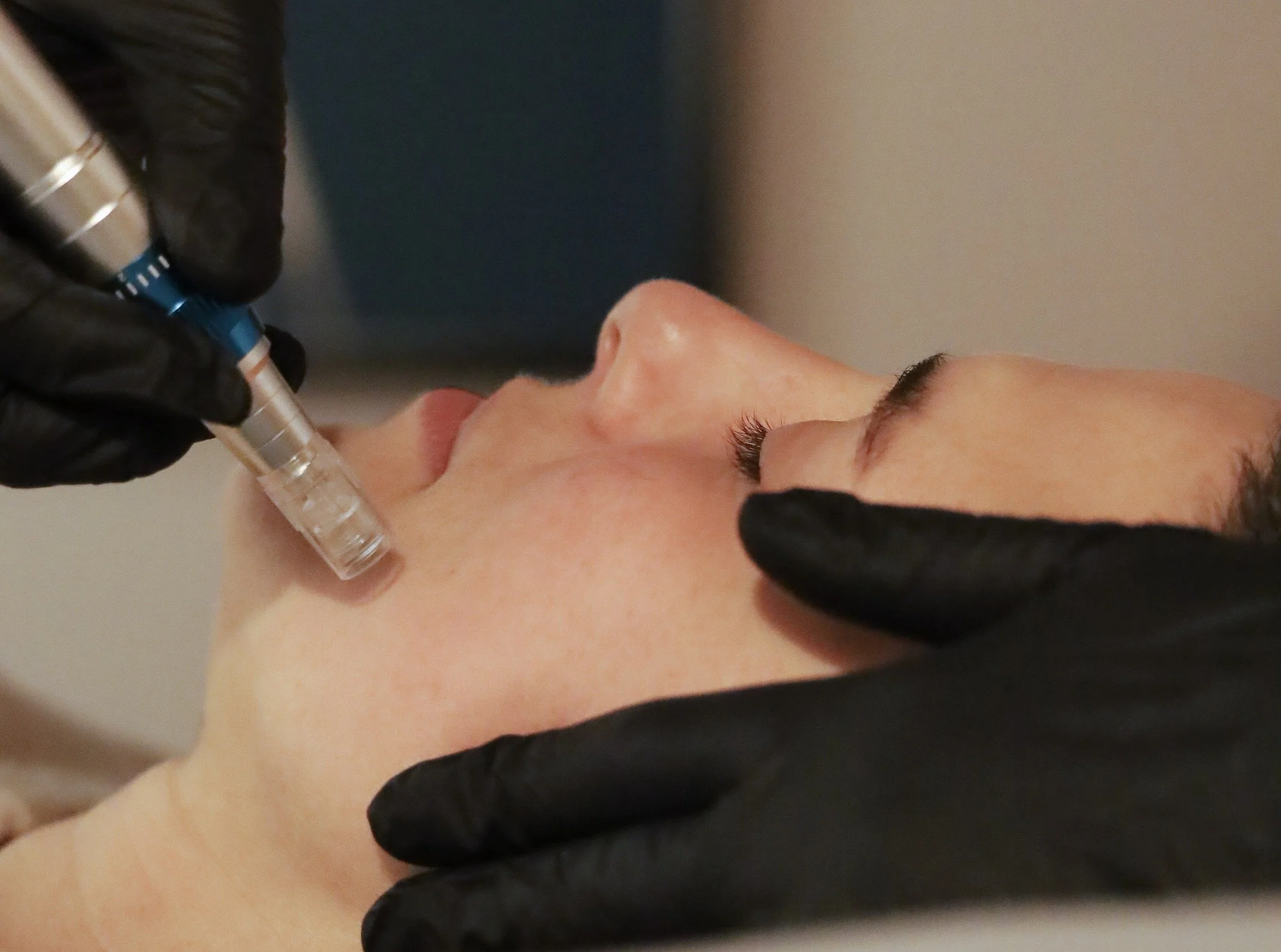 A person receiving a microneedling treatment.