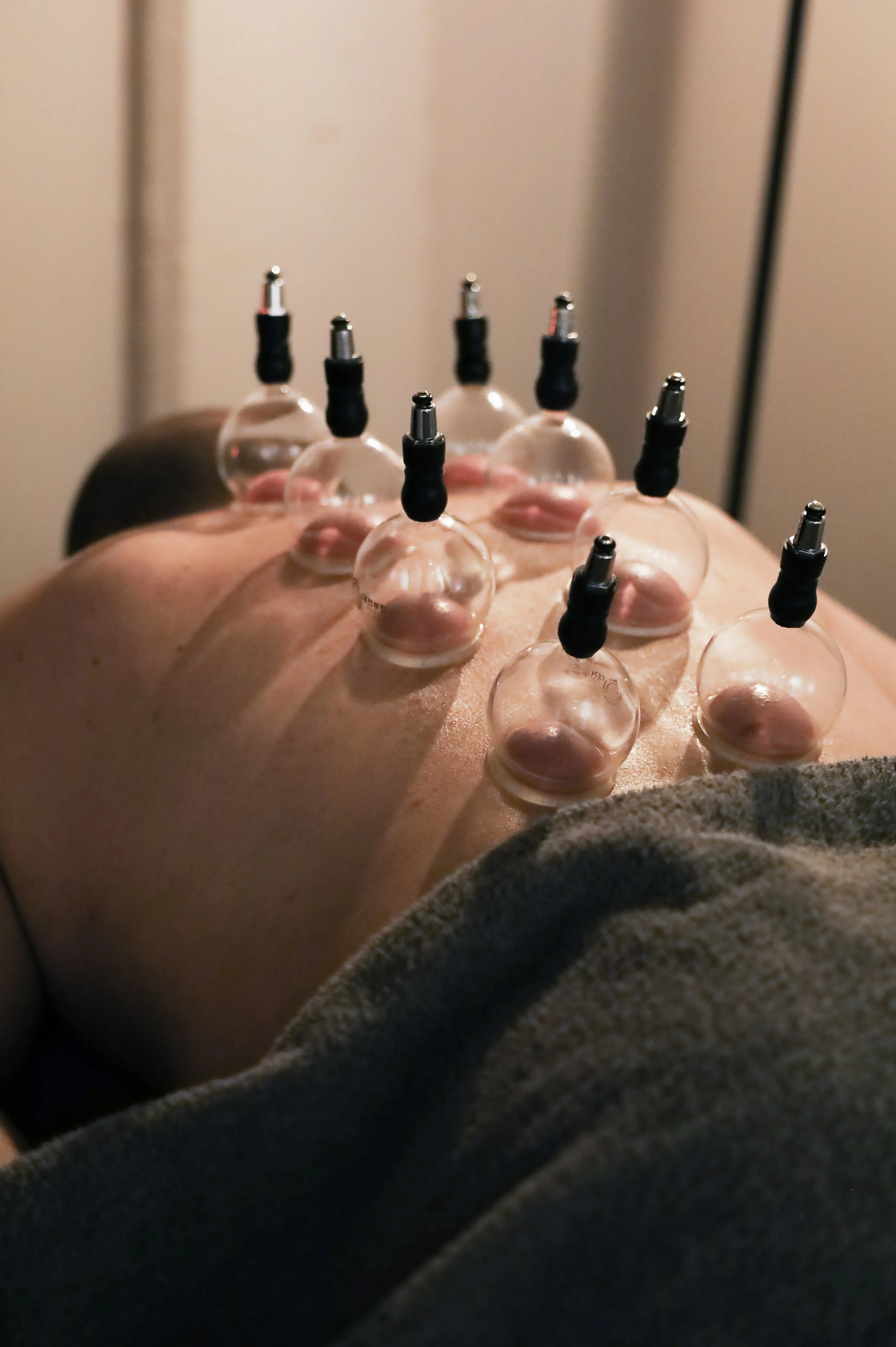 Close-up of a person's back showing a cupping therapy session with multiple glass cups attached to the skin.