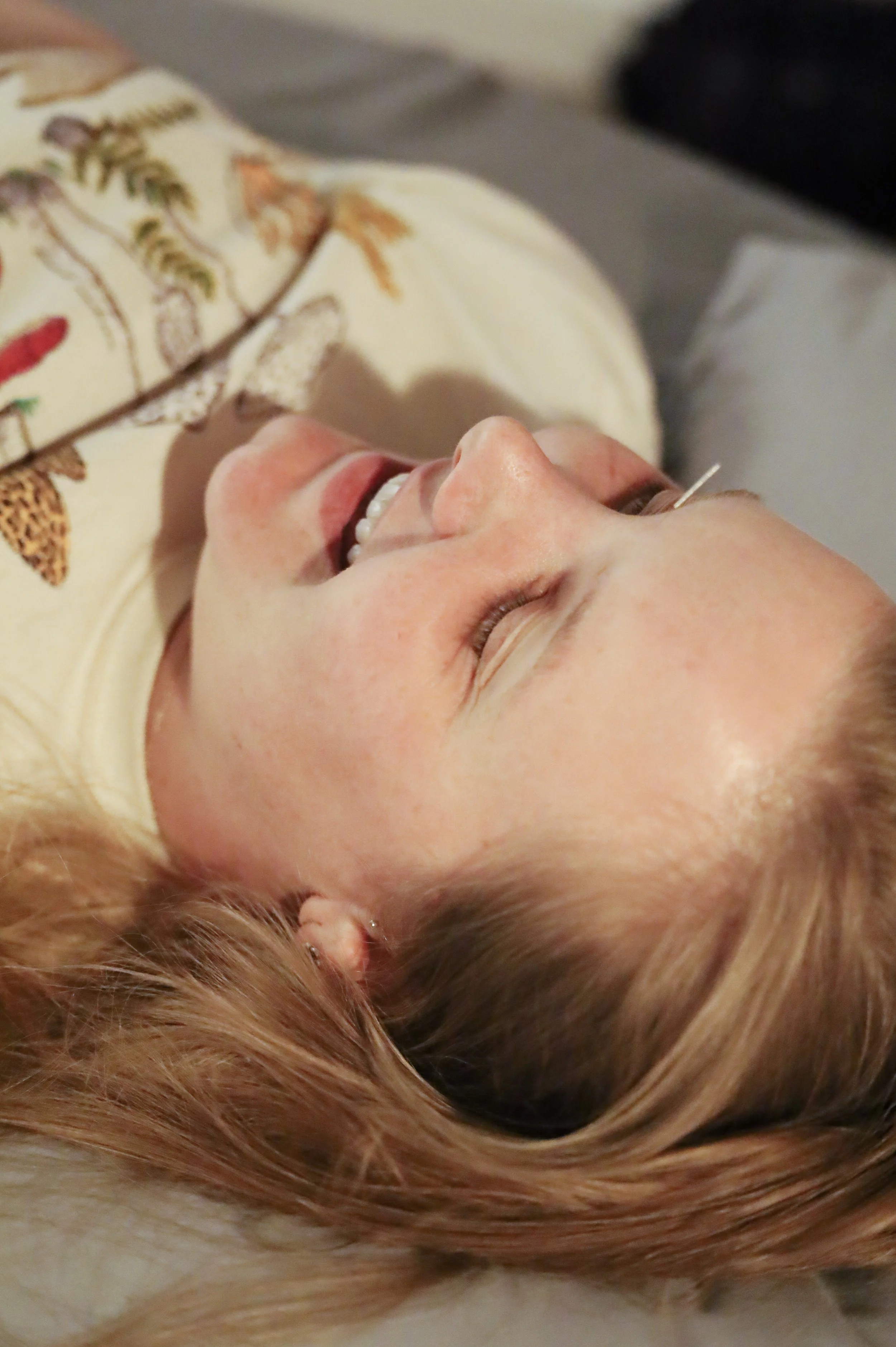 A woman recieving acupuncture, a close up of an acupuncture needle in the yin tang point on the forehead.