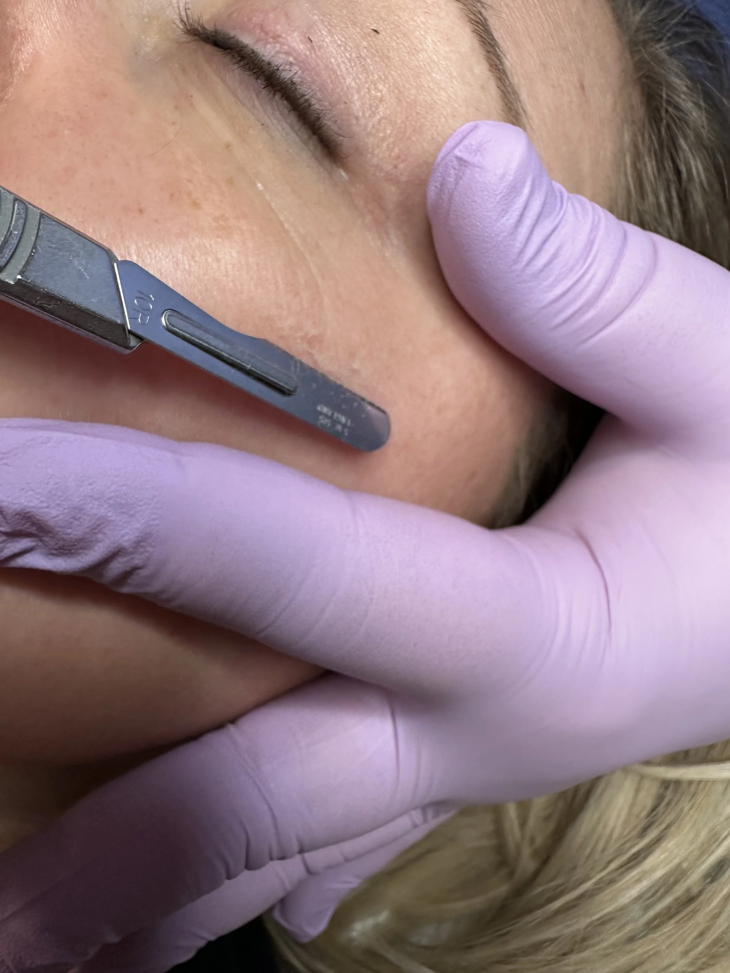 Close-up of a person receiving a facial treatment, with a practitioner using a metal tool on the person's cheek, both wearing light pink gloves.