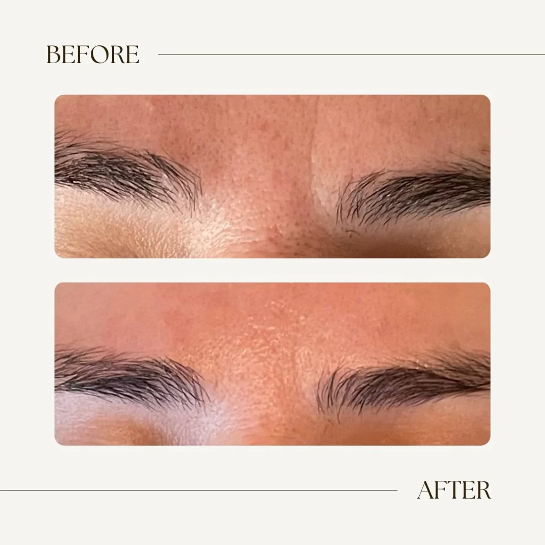 🌀Cosmetic Acupuncture🌀

This sweet client came to me wanting support for developing &ldquo;11&rsquo;s&rdquo; and fine lines on the ridge of her nose. By placing super small needles into and around these lines, we stimulate the body&rsquo;s natural 