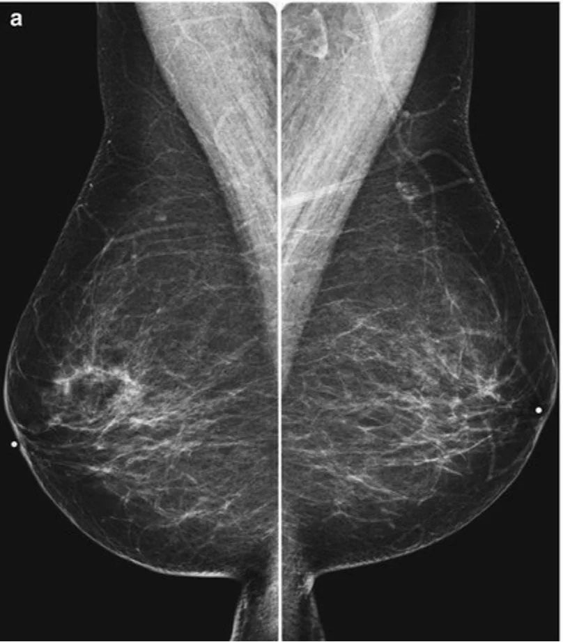 Mammografie — Radiologiepraktijk