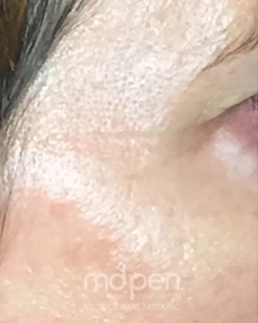 AFTER - photo by @refinerymedspa