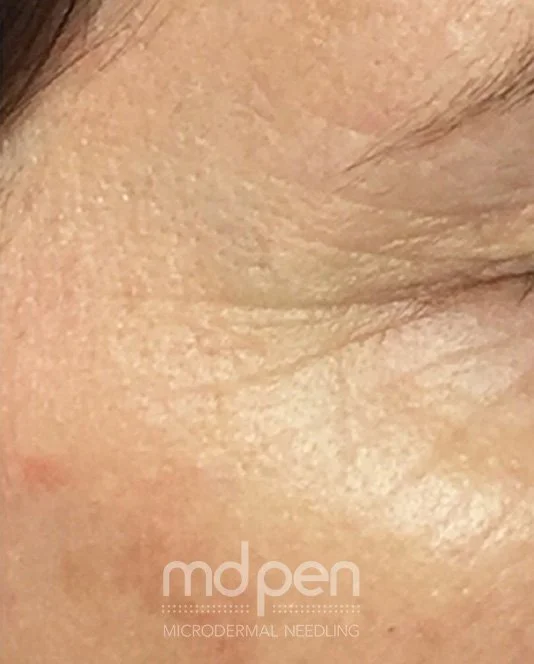 BEFORE - photo by @refinerymedspa