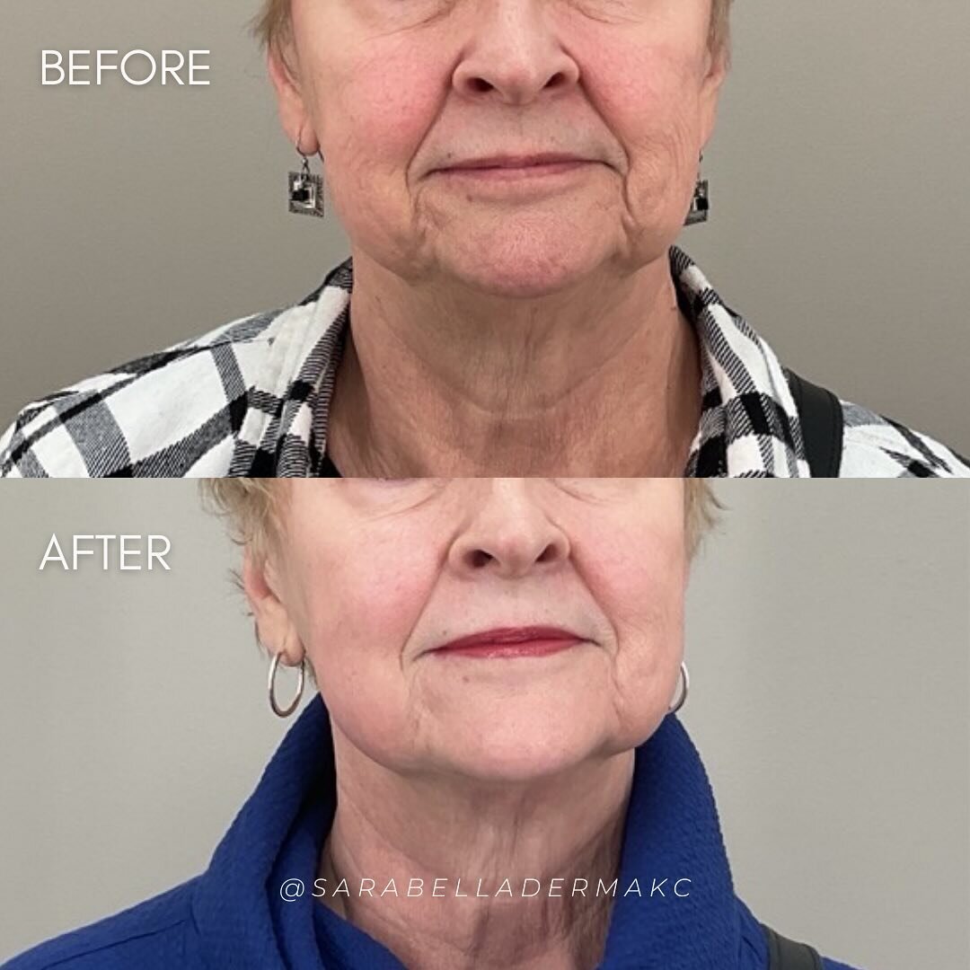 Can we get a 👏 for this transformation? This lovely client came to us wanting to tighten the areas around her lower face and neck area.

We opted for Morpheus to target those deep skin layers. This allowed her skin to stimulate its own collagen prod