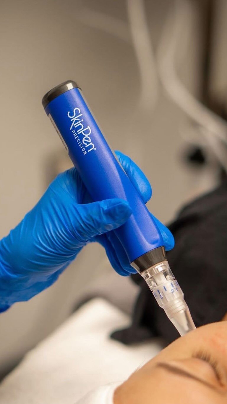 Struggling with uneven skin texture, fine lines, or acne scars? You might be the perfect candidate for microneedling! Book your session today for smoother, glowing skin. β¨
#medspa #medicalspa #aesthetics #kansascity #nurseinjector #esthetician #skin