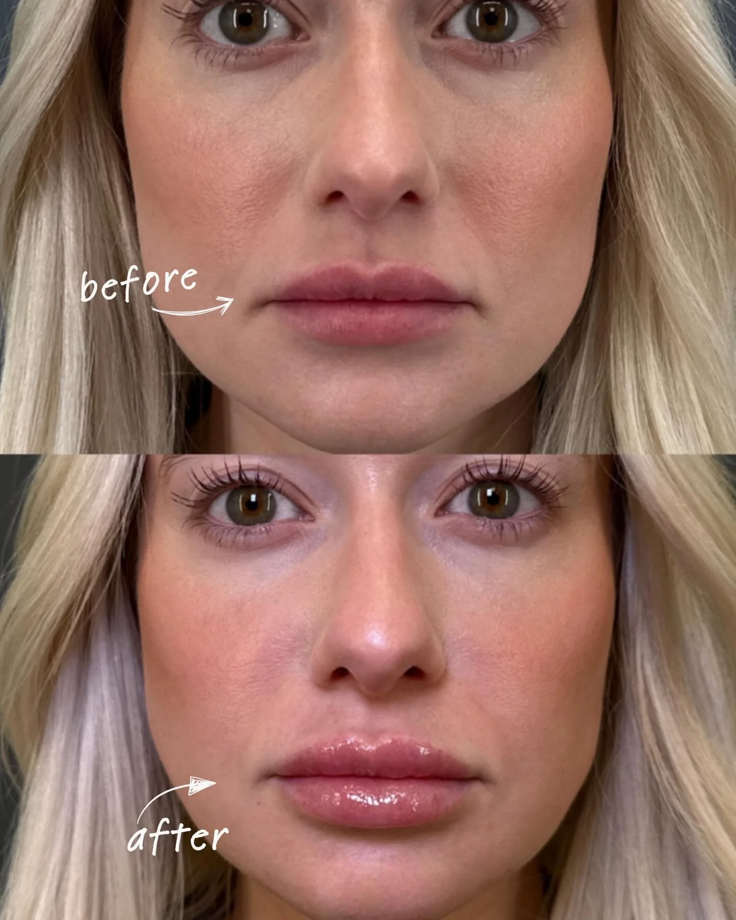Gorgeous lip results! We used RHA Redensity to add subtle hydration and smoothness. She already had filler, so we gave her the perfect touch-up 💉

#lipfiller #medspa #kcmo #kcmedspa #aesthetics