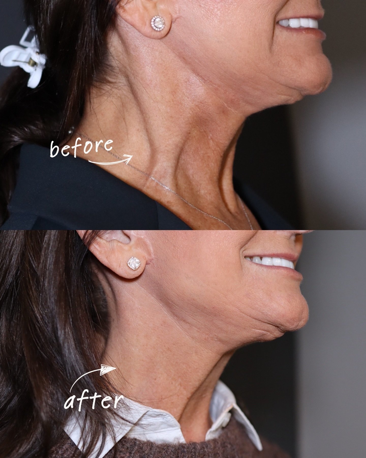 Before &amp; After: Platysma Band Botox 💉&nbsp;

This treatment relaxes the neck muscles to smooth visible bands and define the jawline. Recently FDA-approved (late 2024) and already a favorite for natural-looking results.

If you want to know more 