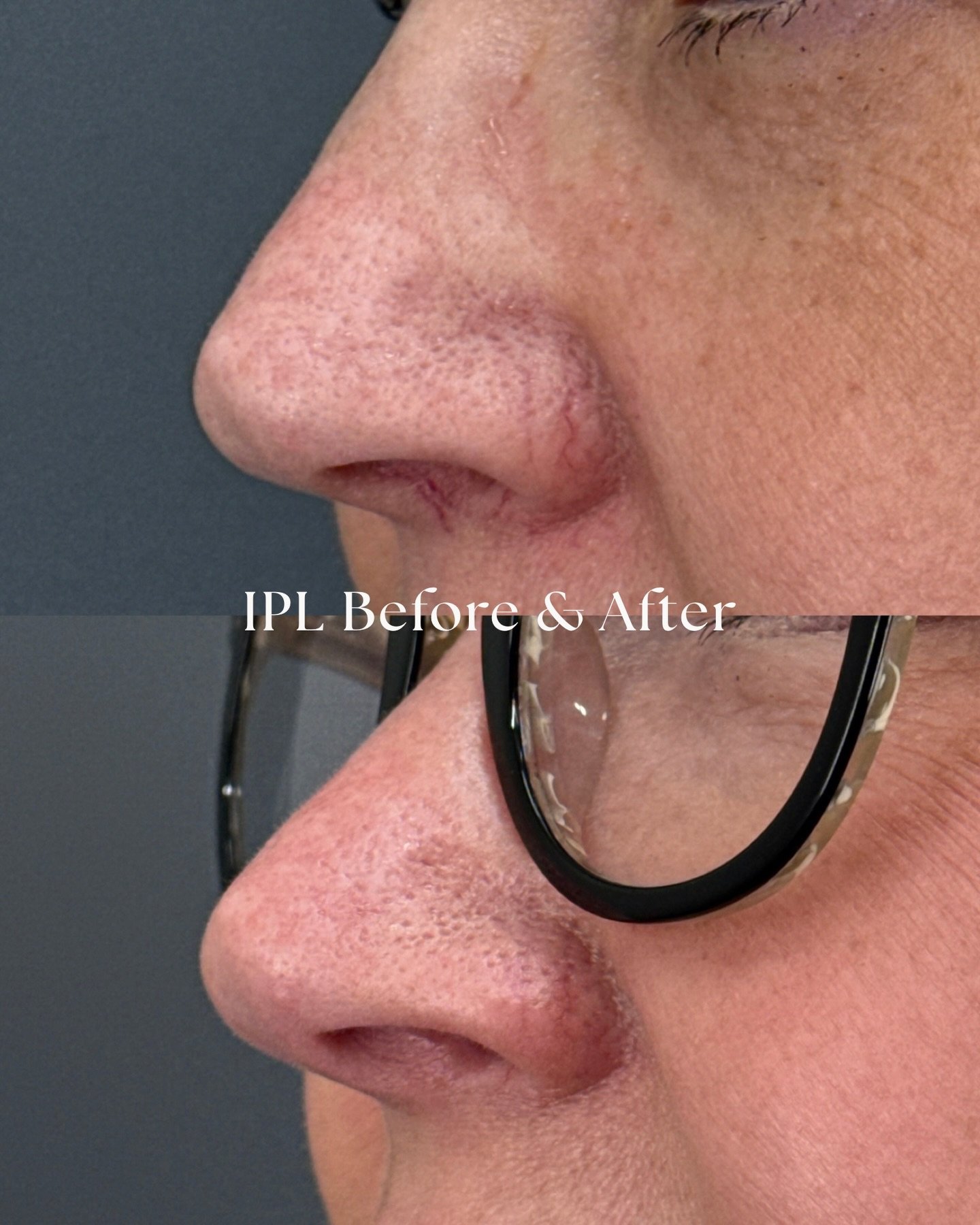 Before ➡️ After

IPL is one of our go-to treatments for reducing stubborn vessels and redness around the nose. This treatment targets visible redness and broken capillaries, helping create a more even, clearer complexion.

Book today or call us for m