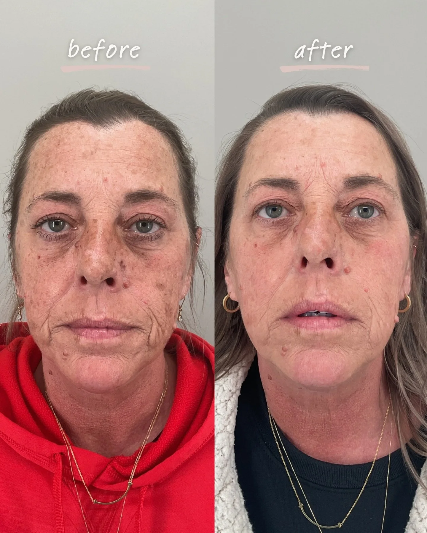 Before ➡️ After IPL

The left photo is before any treatments. The right is taken just before her third IPL session.

After only two treatments, her dark spots are already noticeably brighter, sun damage is fading, and broken capillaries are visibly r