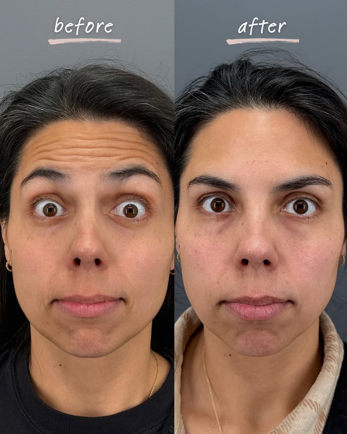 We can&rsquo;t say enough good things about Daxxify! Natural, refreshed results with every appointment 🙌🏼

If you&rsquo;ve been thinking about tox, let this be your sign. Book your appointment now or schedule a complimentary consultation!

#medspa 