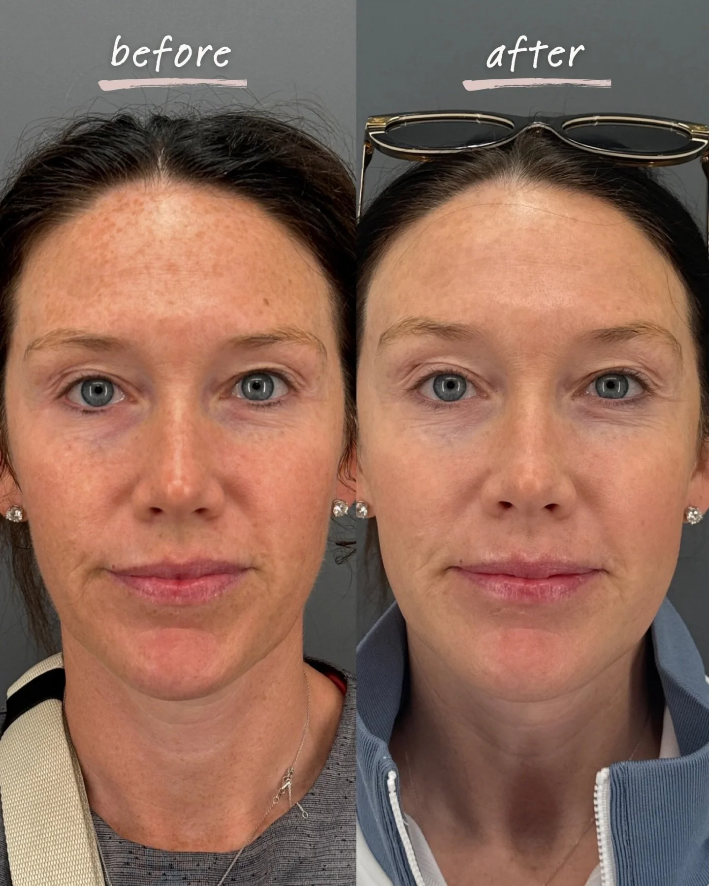 Another wonderful IPL transformation by @aesthetics.by.annaliese ✨🙌🏼

After just two treatments, dark spots are visibly lighter and overall tone is more even! Interested in IPL? Send us a chat or call the office, we&rsquo;d love to create a treatme