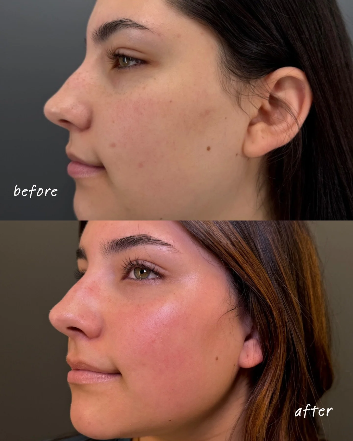 We just love a good skin transformation. Brighter, healthier, glowing skin! ✨

This one-year transformation is the result of consistency with laser treatments, microneedling, and VI Peels 🙌🏼🫶🏼

#medspa #facial #skincare #aesthetics #esthetician
