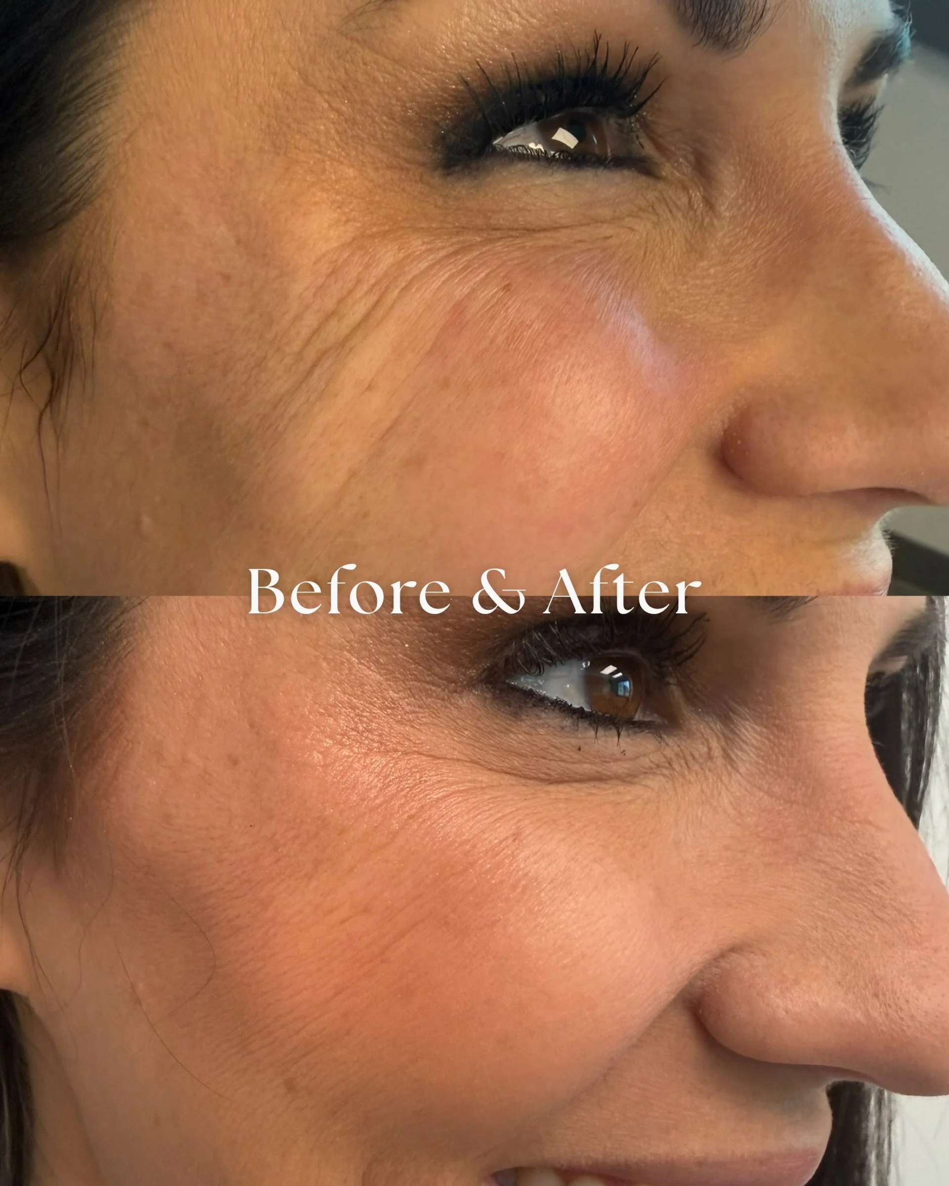 Sculptra before &amp; after!

These photos were taken just 6 weeks apart&hellip;with results that will continue to improve over time.

Sculptra works by stimulating your body&rsquo;s natural collagen production to gradually restore volume and improve