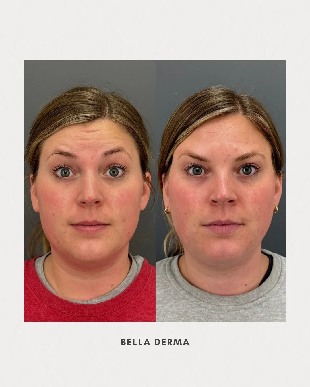 Refreshed, subtle, and glowing ✨

A little before &amp; after of Daxxify showing how soft, smooth, and natural your results can be!