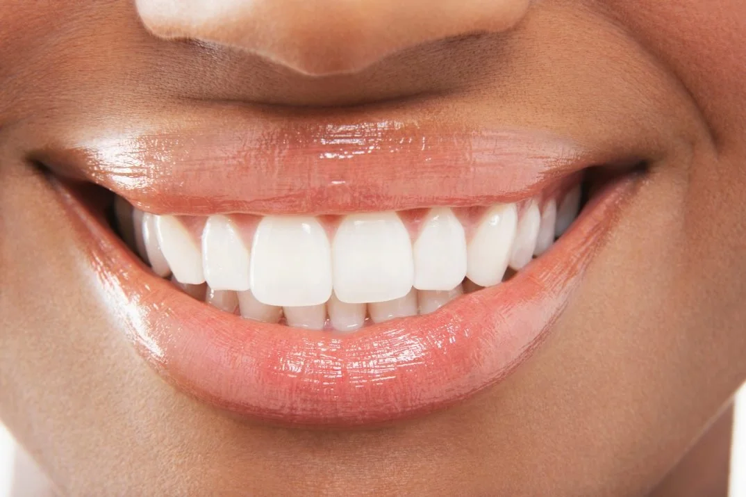 Top Five Teeth Whitening Questions Australians Ask Us