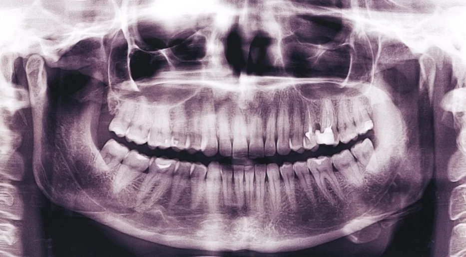 Do Dental X-Rays Show All Types of Cavities?