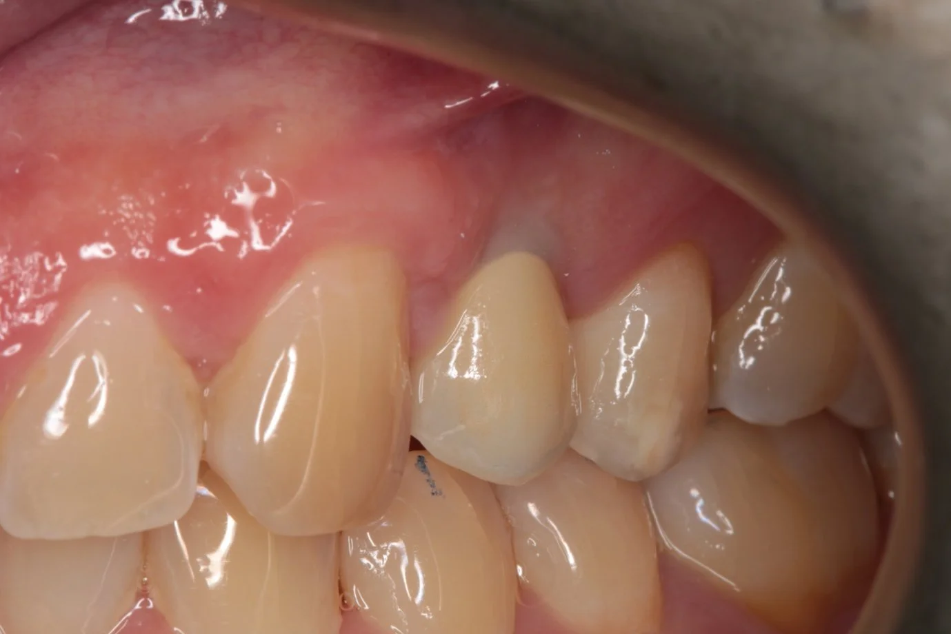 4 of 4. The final zirconia crown on a custom abutment, made in our own lab.