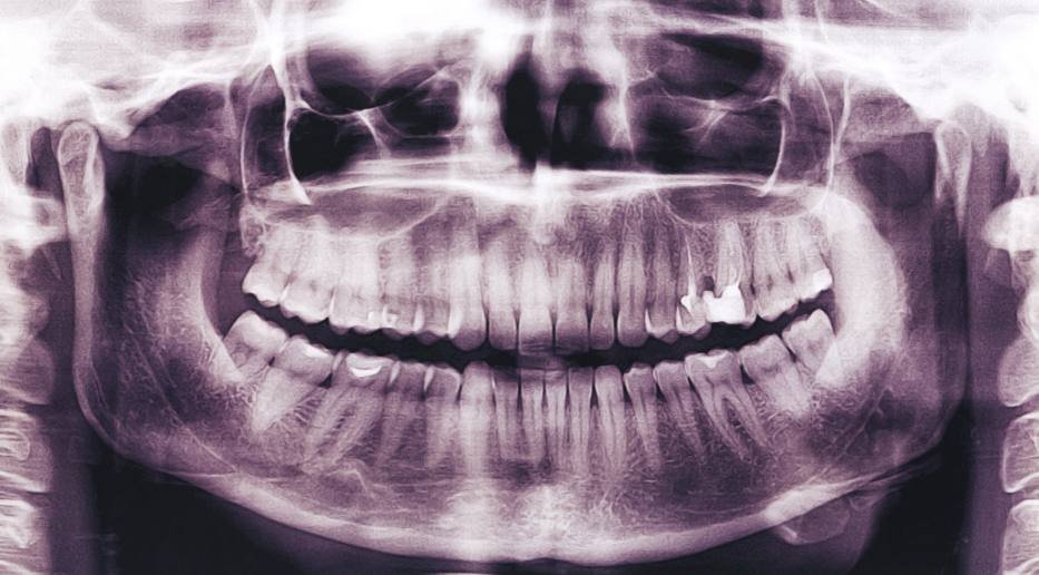Panoramic dental X-ray showing the full upper and lower jaws