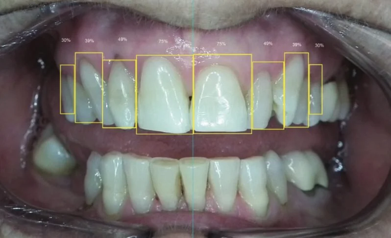 Digital boxes illustrating the relative proportions of the upper front teeth