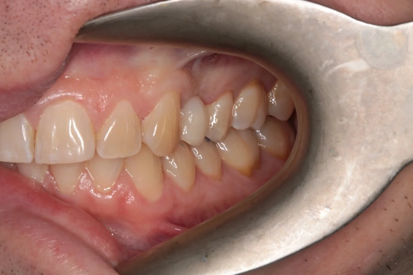 3 of 4. A provisional crown shapes the gum while the implant integrates.