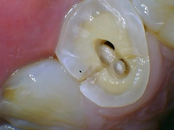 1 of 4. The cracked upper premolar that could not be saved, seen from above.