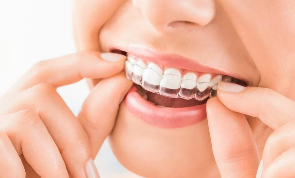 Woman fitting a clear plastic aligner over her upper front teeth