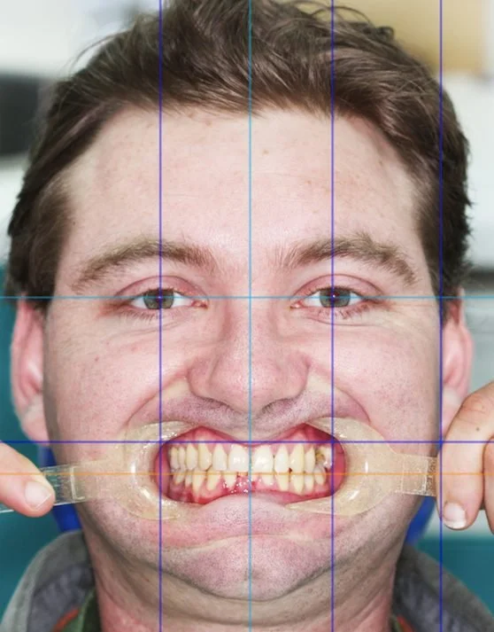 Facial reference lines used to compare tooth alignment with the face