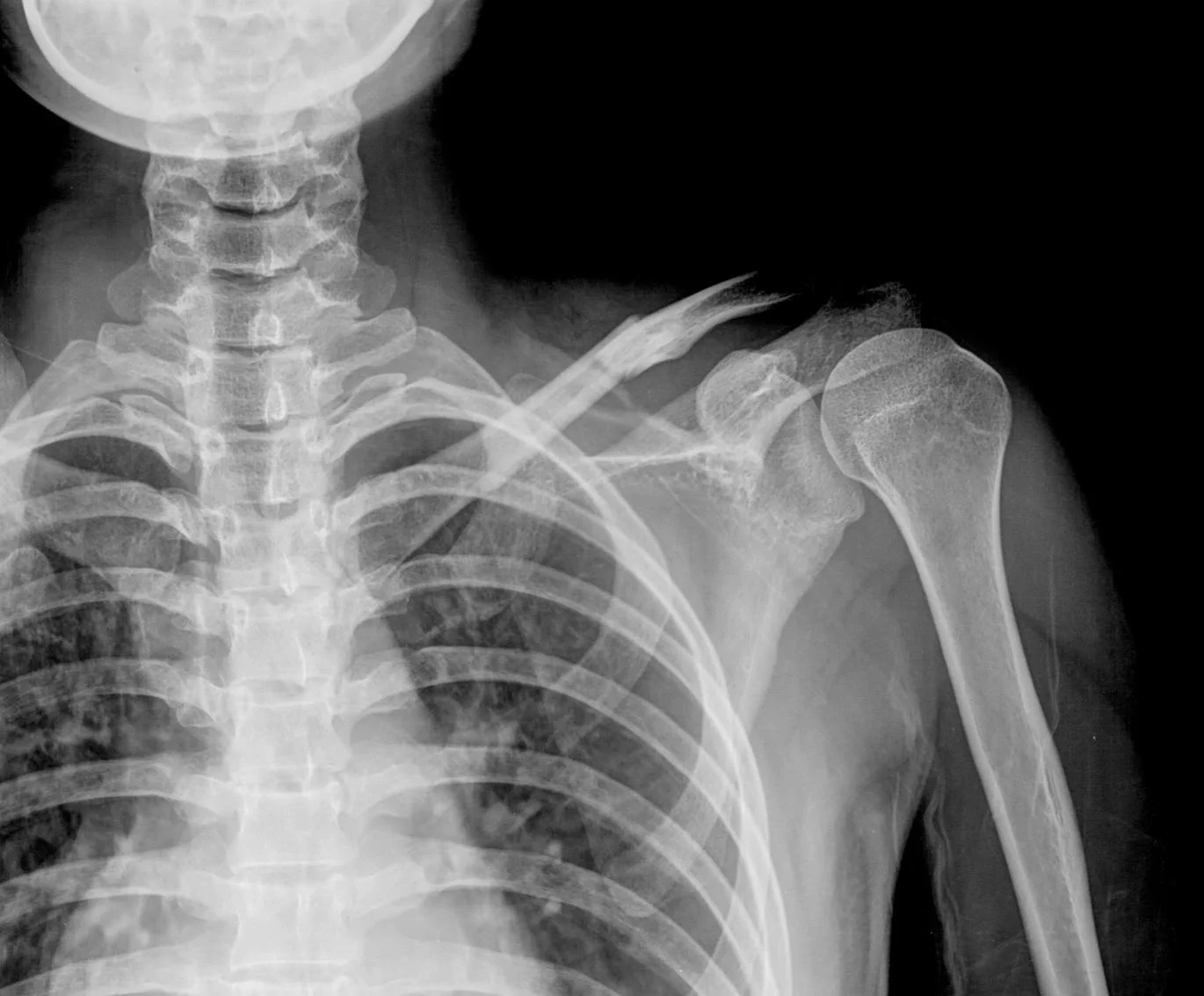 X-ray showing the ribs, collarbone and shoulder joint in grey tones
