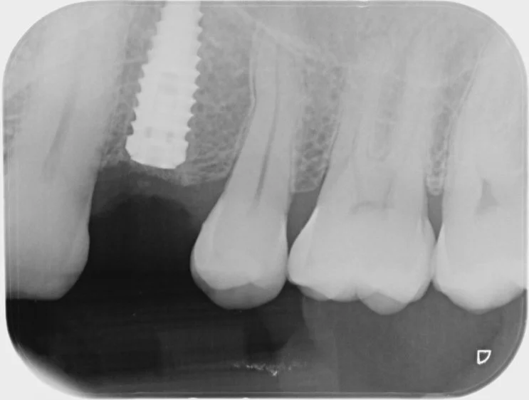 2 of 4. The implant in place, seen on an x-ray, while the bone heals around it.