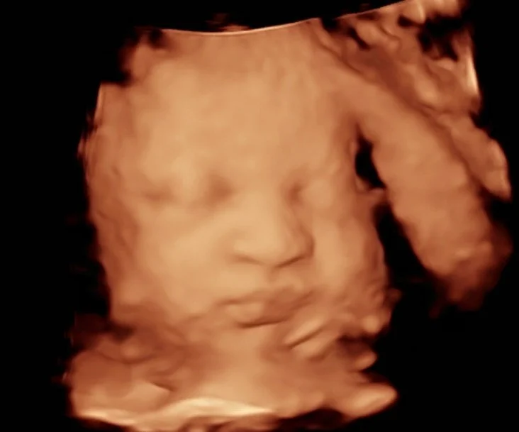 ✨ Our 3D &amp; 5D ultrasounds! ✨
Aren&rsquo;t they beautiful? 💕

👶 3D Ultrasound &ndash; Gives you a clear, still image of your baby&rsquo;s little face, hands, and features in amazing detail. Perfect for capturing those precious first looks!

🌟 5